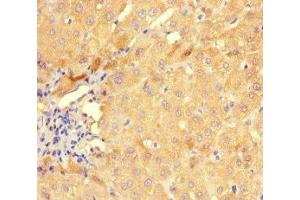 Immunohistochemistry of paraffin-embedded human liver cancer using ABIN7154281 at dilution of 1:100 (GMPR 抗体  (AA 1-345))