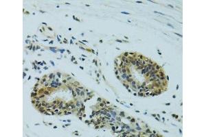 Immunohistochemistry of paraffin-embedded Human breast cancer using NHEJ1 Polyclonal Antibody at dilution of 1:100 (40x lens). (NHEJ1 抗体)