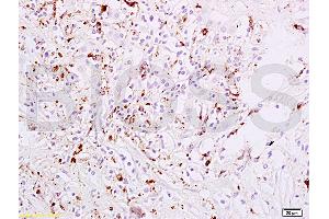 Formalin-fixed and paraffin embedded human liver carcinoma tissue labeled with Anti-phospho-STAT6(Tyr641) Polyclonal Antibody, Unconjugated (ABIN734483) at 1:200 followed by conjugation to the secondary antibody, (SP-0023), and DAB staining (STAT6 抗体  (pTyr641))