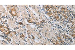 Immunohistochemistry of paraffin-embedded Human gastic cancer using CST3 Polyclonal Antibody at dilution of 1:50 (CST3 抗体)