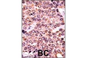 Formalin-fixed and paraffin-embedded human cancer tissue reacted with the primary antibody, which was peroxidase-conjugated to the secondary antibody, followed by AEC staining. (p21 抗体  (pThr145))