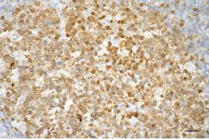 Immunohistochemistry was performed on paraffin-embedded human tonsillitis using caspase 3 antibody (ABIN7797894), 1:100). (Recombinant Caspase 3 抗体)