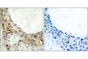 Immunohistochemistry analysis of paraffin-embedded human breast carcinoma, using BCL-2 (Phospho-Ser70) Antibody. (Bcl-2 抗体  (pSer70))