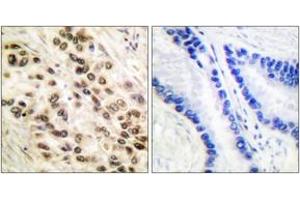 Immunohistochemistry analysis of paraffin-embedded human lung carcinoma tissue, using C/EBP-beta (Ab-235/188) Antibody. (CEBPB 抗体  (AA 201-250))