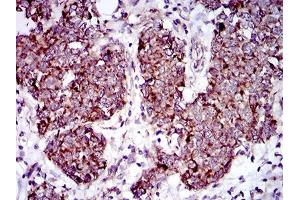 Immunohistochemical analysis of paraffin-embedded breast cancer tissues using MRPL42 mouse mAb with DAB staining. (MRPL42 抗体  (AA 10-142))