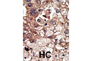 Formalin-fixed and paraffin-embedded human hepatocellular carcinoma tissue reacted with EPS8 polyclonal antibody  , which was peroxidase-conjugated to the secondary antibody, followed by DAB staining. (EPS8 抗体  (N-Term))