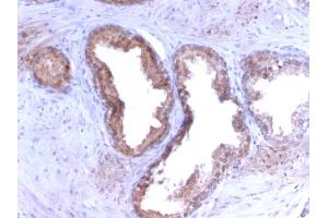 Formalin-fixed, paraffin-embedded human Prostate Carcinoma stained with PSA Rabbit Recombinant Monoclonal Antibody (KLK3/2871R). (Recombinant Prostate Specific Antigen 抗体)