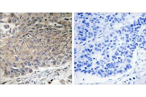 Peptide - +Immunohistochemistry analysis of paraffin-embedded human lung carcinoma tissue using DYNLL2 antibody. (DYNLL2 抗体)