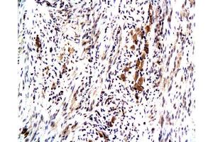 Formalin-fixed and paraffin embedded human colon carcinoma with Anti-Maspin Polyclonal Antibody, Unconjugated at 1:200, followed by conjugation to the secondary antibody and DAB staining (SERPINB5 抗体  (AA 301-375))