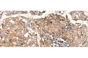 Immunohistochemistry of paraffin-embedded Human esophagus cancer tissue using CACNA2D2 Polyclonal Antibody at dilution of 1:45(x200) (CACNA2D2 抗体)