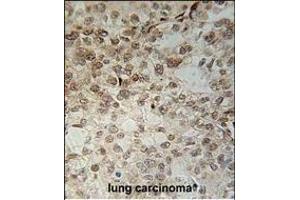 C14orf179 Antibody (Center) (ABIN651563 and ABIN2840304) immunohistochemistry analysis in formalin fixed and paraffin embedded human lung carcinoma followed by peroxidase conjugation of the secondary antibody and DAB staining. (IFT43 抗体  (AA 145-171))