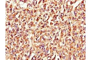 Immunohistochemistry of paraffin-embedded human melanoma using ABIN7158215 at dilution of 1:100 (LSMEM1 抗体  (AA 1-131))