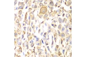 Immunohistochemistry of paraffin-embedded human lung cancer using CD151 antibody (ABIN3023660, ABIN3023661, ABIN3023662, ABIN1679069 and ABIN6219074) at dilution of 1:200 (40x lens). (CD151 抗体  (AA 113-221))