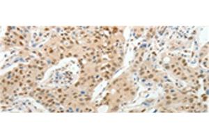 Immunohistochemistry of paraffin-embedded Human lung cancer tissue using UNC5CL Polyclonal Antibody at dilution of 1:50(x200) (UNC5CL 抗体)