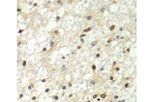 Immunohistochemistry of paraffin-embedded Human brain cancer using ZBTB48 Polyclonal Antibody at dilution of 1:100 (40x lens). (ZBTB48 抗体)