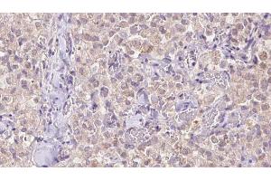 ABIN6273343 at 1/100 staining Human thyroid cancer tissue by IHC-P. (VDAC3 抗体  (N-Term))