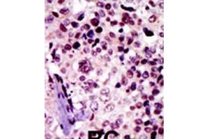 Formalin-fixed and paraffin-embedded human cancer tissue reacted with the primary antibody, which was peroxidase-conjugated to the secondary antibody, followed by AEC staining. (Protein Kinase A beta (AA 50-80), (N-Term), (Regulatory Subunit 1) 抗体)