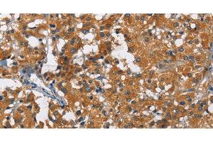 Immunohistochemistry of paraffin-embedded Human thyroid cancer using KLF7 Polyclonal Antibody at dilution of 1:60 (KLF7 抗体)