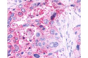 Anti-GPR61 antibody IHC of human Pancreas, Carcinoma. (GPR61 抗体  (C-Term))
