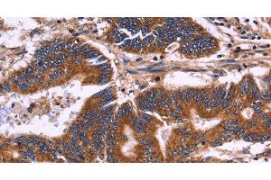 Immunohistochemistry of paraffin-embedded Human colon cancer tissue using KIR2DL1/3/4/S4 Polyclonal Antibody at dilution 1:30 (KIR2DL1/3/4/S4 抗体)