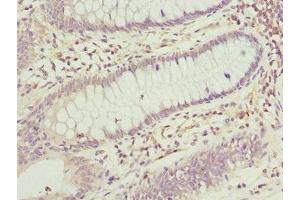 Immunohistochemistry of paraffin-embedded human colon cancer using ABIN7165174 at dilution of 1:100 (TNRC5 抗体  (AA 31-278))