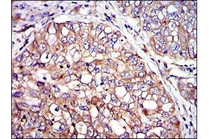 Immunohistochemical analysis of paraffin-embedded lung cancer tissues using CRK mouse mAb with DAB staining. (Crk 抗体)