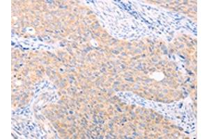 The image on the left is immunohistochemistry of paraffin-embedded Human cervical cancer tissue using ABIN7131482(TRIM32 Antibody) at dilution 1/40, on the right is treated with fusion protein. (TRIM32 抗体)