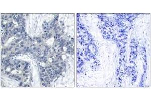 Immunohistochemistry analysis of paraffin-embedded human breast carcinoma, using PYK2 (Phospho-Tyr402) Antibody. (PTK2B 抗体  (pTyr402))