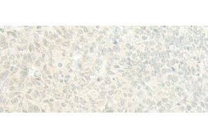 Immunohistochemistry of paraffin-embedded Human ovarian cancer tissue using ESRP2 Polyclonal Antibody at dilution of 1:95(x200) (ESRP2 抗体)