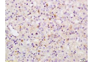 Formalin-fixed and paraffin embedded human brain glioma tissue labeled with Anti-Phospho-Wee1(Ser642) Polyclonal Antibody, Unconjugated  at 1:200 followed by conjugation to the secondary antibody and DAB staining (WEE1 抗体  (pSer642))