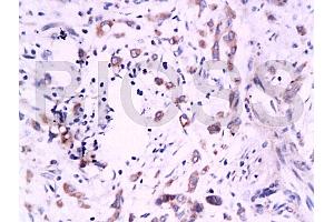 Formalin-fixed and paraffin embedded human colon carcinoma labeled Anti-B7H4 Polyclonal Antibody, Unconjugated (ABIN671736) at 1:200, followed by conjugation to the secondary antibody and DAB staining (VTCN1 抗体  (AA 50-100))