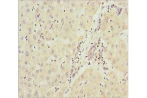 Immunohistochemistry of paraffin-embedded human liver cancer using ABIN7160913 at dilution of 1:100 (NDUFA9 抗体  (AA 1-270))