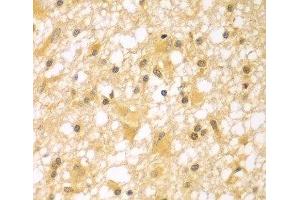 Immunohistochemistry of paraffin-embedded Human brain cancer using PAK6 Polyclonal Antibody at dilution of 1:100 (40x lens). (PAK6 抗体)