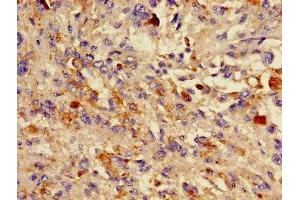 Immunohistochemistry of paraffin-embedded human melanoma using ABIN7157786 at dilution of 1:100 (DCT 抗体  (AA 44-205))