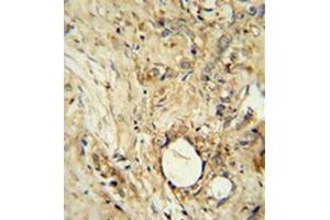 Immunohistochemistry analysis in formalin fixed and paraffin embedded human breast carcinoma reacted with AP52256PU-N, which was peroxidase conjugated to the secondary antibody and followed by DAB staining. (ITIH5 抗体  (C-Term))