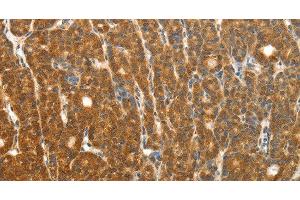 Immunohistochemistry of paraffin-embedded Human thyroid cancer using PTCH1 Polyclonal Antibody at dilution of 1:50 (Patched 1 抗体)