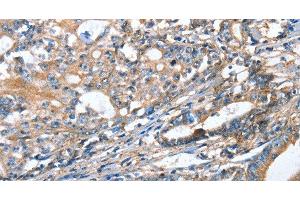 Immunohistochemistry of paraffin-embedded Human gastric cancer using AKR1D1 Polyclonal Antibody at dilution of 1:35 (AKR1D1 抗体)