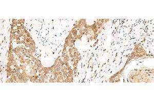 Immunohistochemistry of paraffin-embedded Human esophagus cancer tissue using PPP1R3C Polyclonal Antibody at dilution of 1:50(x200) (PPP1R3C 抗体)