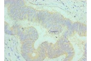 Immunohistochemistry of paraffin-embedded human colon cancer using ABIN7144372 at dilution of 1:100 (AP2M1 抗体  (AA 136-435))