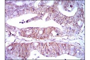 Immunohistochemical analysis of paraffin-embedded rectum cancer tissues using LPA mouse mAb with DAB staining. (Lp(a) 抗体  (AA 1823-2013))