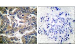 Immunohistochemistry analysis of paraffin-embedded human breast carcinoma, using GR (Phospho-Ser211) Antibody. (GR (AA 181-230), (pSer211) 抗体)