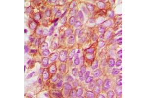 Immunohistochemical analysis of BAX staining in human breast cancer formalin fixed paraffin embedded tissue section. (BAX 抗体  (Center))