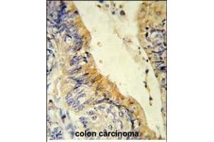 Formalin-fixed and paraffin-embedded human colon carcinoma reacted with ACADM Antibody (Center), which was peroxidase-conjugated to the secondary antibody, followed by DAB staining. (Medium-Chain Specific Acyl-CoA Dehydrogenase, Mitochondrial (MCAD) (AA 189-217) 抗体)