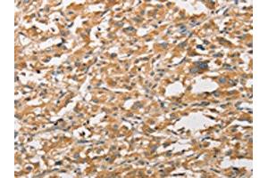 The image on the left is immunohistochemistry of paraffin-embedded Human thyroid cancer tissue using ABIN7131608(WNT11 Antibody) at dilution 1/20, on the right is treated with fusion protein. (WNT11 抗体)
