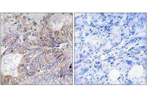 Immunohistochemistry analysis of paraffin-embedded human breast carcinoma tissue, using BAD (Ab-155) Antibody. (BAD 抗体  (AA 119-168))