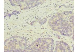 Immunohistochemistry of paraffin-embedded human gastric cancer using ABIN7145326 at dilution of 1:100