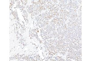 Immunohistochemistry (IHC) image for anti-AT Rich Interactive Domain 1A (SWI-Like) (ARID1A) (AA 750-800) antibody (ABIN7795677)