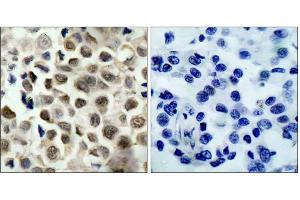 Immunohistochemical analysis of paraffin-embedded human lung carcinoma tissue, using HDAC8 (phospho-Ser39) antibody (E011128). (HDAC8 抗体  (pSer39))