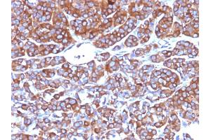 Formalin-fixed, paraffin-embedded human Melanoma stained with Moesin Mouse Monoclonal Antibody (MSN/492). (Moesin 抗体)