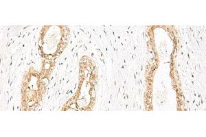 Immunohistochemistry of paraffin-embedded Human breast cancer tissue using JPT1 Polyclonal Antibody at dilution of 1:35(x200) (JPT1 抗体)